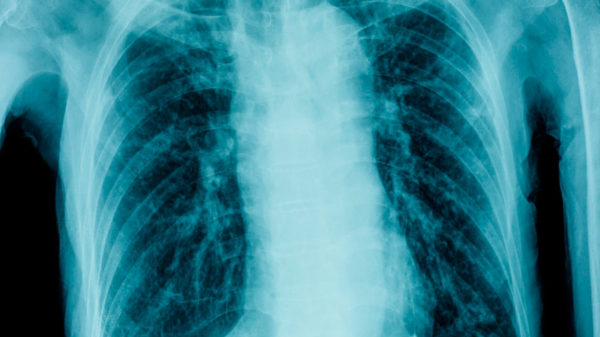 Flail Chest Injuries Acute Then Chronic Respiratory Impairment