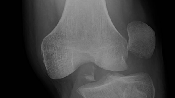 Dislocation of the Knee Diverse Injuries Diverse Outcomes