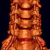 Vertebral Artery Dissection Lifetime Treatment Required