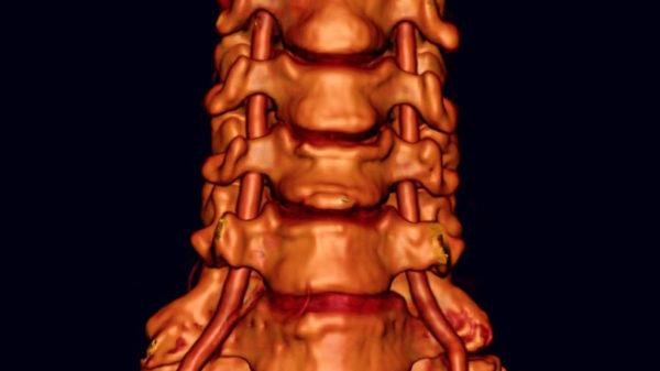 Vertebral Artery Dissection Lifetime Treatment Required