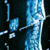 Compressive Peripheral Nerve Injuries in SCI