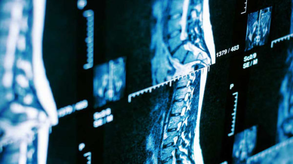 Compressive Peripheral Nerve Injuries in SCI