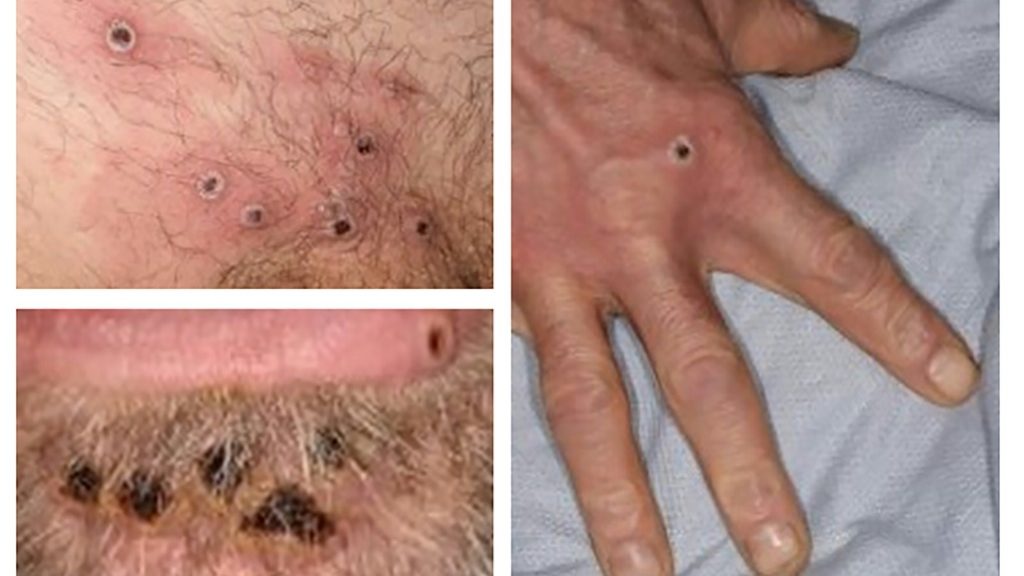WHO Emergency Committee decides on monkeypox outbreak - Health and Lifestyle News - Report by AFR | Online Free Press release news distribution - Vimarsana News