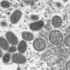 Why monkeypox might soon get a new name Health
