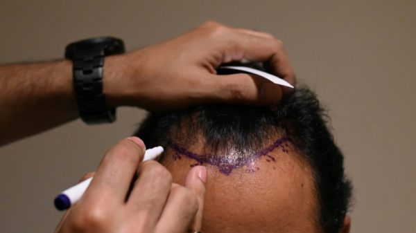 Hair transplant fad turns deadly in India